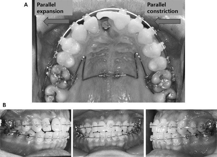 Figure 5. . Case 1 during treatment. (A) Lingual arch type midpalatal miniscrew connecting wire for asymmetric transverse control of maxillary dentition. Right side was expanded and left side was constricted. (B) Intraoral photos during treatment.