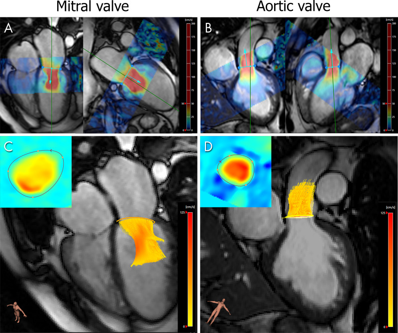 Forward flow quantification with four-dimensional (4D) flow MRI across the mitral valve (MV) and aortic valve in a 45-year-old man with moderate MV regurgitation diagnosed with echocardiography. A, B, Semiautomated valve tracking on two orthogonal long-axis cine balanced steady-state free precession images for each valve. Colors represent the in-plane velocity measured with 4D flow MRI. C, D, The 4D flow MRI through-plane velocity measurements are projected onto the valve-tracking plane (inset), and time-resolved streamlines are generated from within the contour.