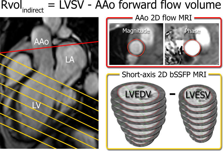 Indirect quantification of regurgitant volume (RvolINDIRECT) by using short-axis balanced steady-state free precession (bSSFP) MRI in the left ventricle (LV) (yellow) and two-dimensional (2D) flow MRI in the ascending aorta (AAo) (red). Slice locations are indicated on a three-chamber bSSFP image (left). Semiautomated contouring of the aortic flow area (top right) and the LV endocardial borders at end diastole and end systole (bottom right) allows for quantification of the ascending aorta forward flow volume and LV stroke volume (LVSV) and calculation of RvolINDIRECT. LA = left atrium, LVEDV = LV end-diastolic volume, LVESV = LV end-systolic volume.