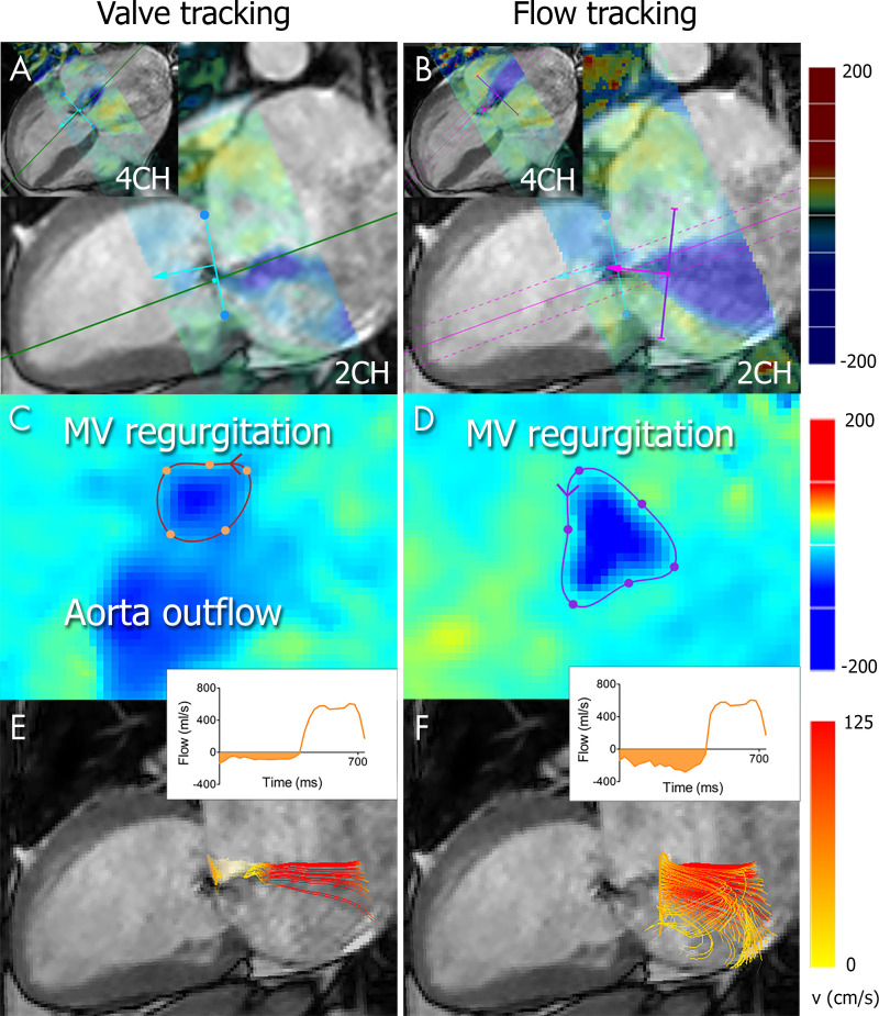 Regurgitant volume quantification with four-dimensional (4D) flow MRI in a 38-year-old woman with severe mitral valve (MV) regurgitation diagnosed with echocardiography. A, B, The location of the MV annulus is identified on two-chamber (2CH) and four-chamber (4CH) cine balanced steady-state free precession images, followed by, A, automatic valve tracking throughout the cardiac cycle. During regurgitation, an additional plane is initialized to enable, B, flow tracking at a 1–2-cm distance from the regurgitant orifice and perpendicular to the direction of the regurgitant jet. Colors represent in-plane 4D flow MRI velocities projected onto the long-axis cine views. C, D, The 4D flow MRI through-plane velocity measurements are projected onto the valve-tracking or flow-tracking plane, allowing for detailed contouring of the flow region of interest. E, F, Time-resolved streamlines are generated from within the contour, and the flow is quantified (inset).