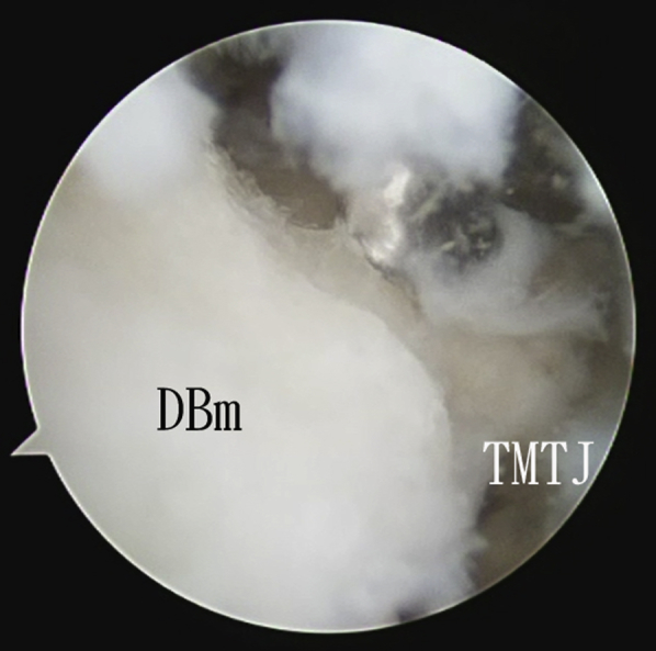 Endoscopic Resection of Dorsal Boss of the Second and Third ...