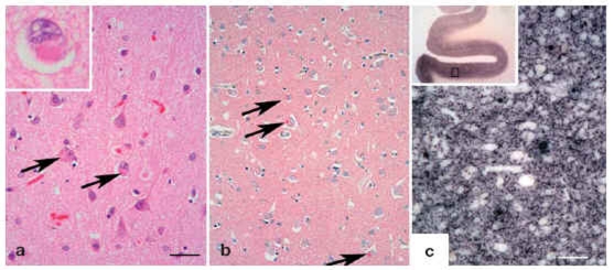 Figure 2: Histology in dementia