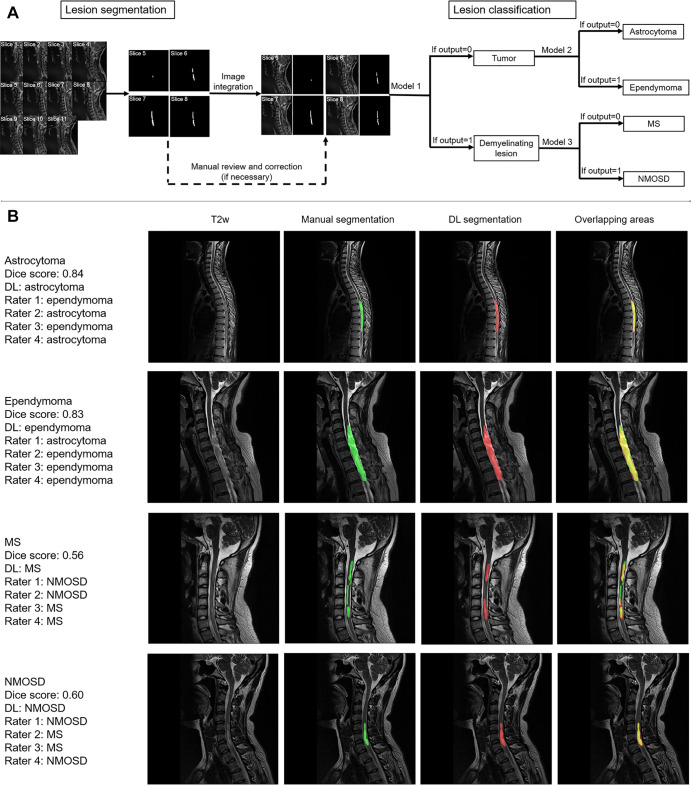 (A) Deep learning (DL) pipeline established for segmentation and classification of spinal cord lesions. First, the noncontrast T2-weighted (T2w) sagittal MR images (all sections; sections 1–11 herein) were used to segment the lesion, and manual verification was conducted to correct the poorly segmented lesions. Second, the sections (eg, sections 5–8) of the T2-weighted images involving lesions and lesion masks were used as the network input for classification tasks. (B) Representative cases of segmentation and classification for spinal cord tumors and demyelinating lesions in the test cohort. Diagnosis by DL and four raters (D.C. [rater 1], X.X. [rater 2], C.F. [rater 3], X.H. [rater 4]) are shown. Red areas indicate the DL segmentation, green areas indicate manual segmentation, and yellow areas indicate overlap. MS = multiple sclerosis, NMOSD = neuromyelitis optica spectrum disorders.