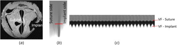 (a) Postoperative MRI scan showing VF medialized by a unilateral suture (left side) and by silastic implant insertion (right side). The length between the anterior and posterior commissure is represented byL. (b) Image from the HSV showing an instantaneous moment of the VF vibration, where the straight line is where thekymograph was taken. (c) Kymograph showing VF vibration over time at the medialized state (configuration 3).
