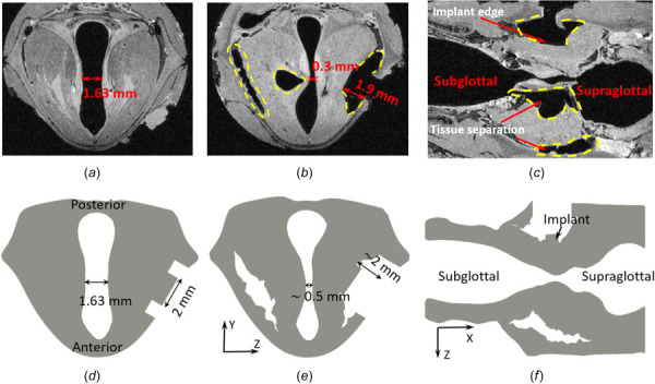 Comparison of VF displacement between the MRI images (a)–(c) and the numerical simulation (d)–(f). (a), (d) The initial rest configuration; (b), (e) medialized configuration in the axial view; (c), (f) medialized configuration in the coronal view. The dashed line in (b) and (c) indicates the tissues separation from the medialization.