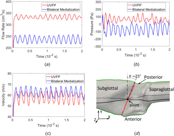 Comparison between UVFP and medialized configurations for the flowrate (a),pressure (b), and flow velocity (c). The pressure and flow velocity were taken around midpoint in the glottis shown in (d).