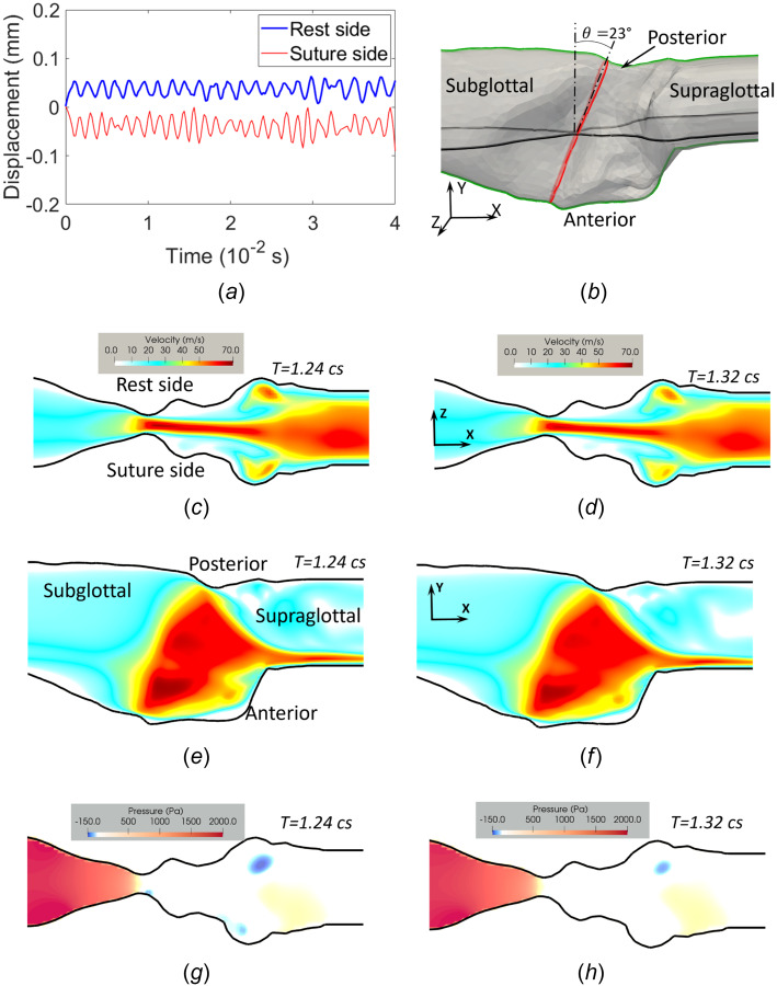 FSI simulation results for the UVFP configuration. (a) Displacement of the two VF sides measured around midpoint of the glottis. (b) The flow domain showing the coronal plane (horizontal slice in the figure) and the midsagittal plane (vertical slice) for visualization; also included is the orientation of the glottis. (c), (d) Velocity magnitude at the closing phase (c) and opening phase (d) in the coronal plane. (e), (f) Velocity magnitude at the closing phase (e) and opening phase (f) in the midsagittal plane. (g), (h) Pressure distribution in the coronal plane for the closing (g) and opening (h) phases.