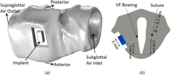 The FEM model showing the implant (a), and a slice in the transverse plane showing the positions of implant and suture (b)