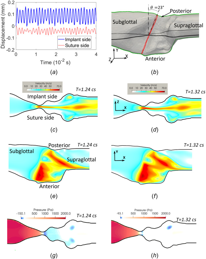 FSI simulation results for the medialized configuration. (a) Displacement of the two VF sides measured around midpoint of the glottis. (b) The flow domain showing the coronal plane (horizontal slice in the figure) and the midsagittal plane (vertical slice) for visualization; also included is the orientation of the glottis. (c), (d) Velocity magnitude at the closing phase (c) and opening phase (d) in the coronal plane. (e), (f) Velocity magnitude at the closing phase (e) and opening phase (f) in the midsagittal plane. (g), (h) Pressure distribution in the coronal plane for the closing (g) and opening (h) phases.