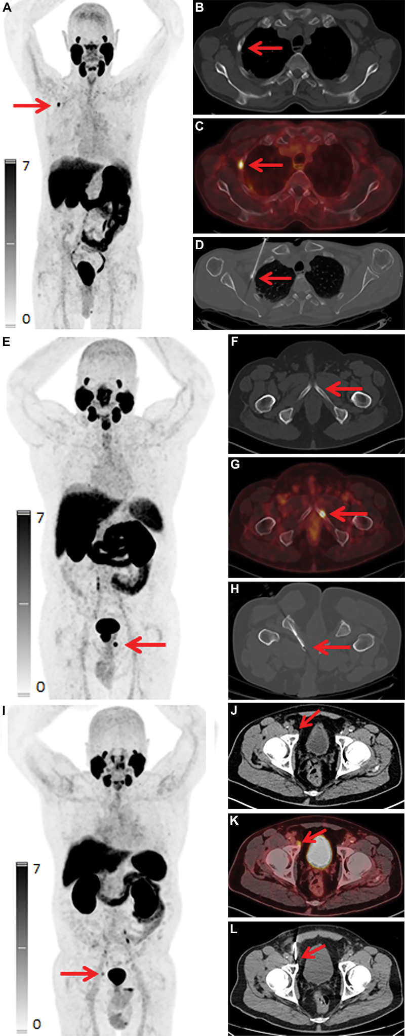 Examples of 2-(3-{1-carboxy-5-[(6-[(18)F]fluoro-pyridine-3-carbonyl)-amino]-pentyl}-ureido)-pentanedioic acid (DCFPyL)–avid lesions with benign pathologic findings at biopsy. Red arrows highlight the lesions with benign biopsy results. (A–D) DCFPyL maximum intensity projection image (A), axial CT scan (B), axial fused DCFPyL PET/CT scan (C), and CT scan obtained during image-guided biopsy (D) of a DCFPyL-avid (standardized uptake value, 6.9) right second rib sclerosis in a 68-year-old man with prostate cancer after prostatectomy and salvage radiation. Prostate-specific antigen (PSA) level was 1.0 ng/mL. (E–H) DCFPyL maximum intensity projection image (E), axial CT scan (F), axial fused DCFPyL PET/CT scan (G), and CT scan obtained during image-guided biopsy (H) of DCFPyL-avid (standardized uptake value, 12.7) left inferior pubic ramus sclerosis in a 59-year-old man with newly diagnosed prostate cancer (Gleason score, 8; PSA level, 19.7 ng/mL). (I–L) DCFPyL maximum intensity projection image (I), axial CT scan (J), axial fused DCFPyL PET/CT scan (K), and CT scan obtained during image-guided biopsy (L) of a DCFPyL-avid (standardized uptake value, 4.7) subcentimeter right external iliac node in a 61-year-old man with prostate cancer after prostatectomy. PSA level was 0.4 ng/mL. In each of these men, the biopsy results were benign.