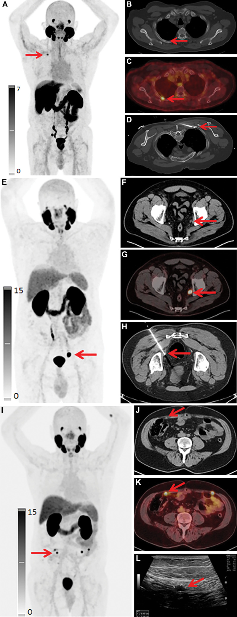 Examples of biopsy-proven distant metastases and sites of biochemical recurrence. Red arrows highlight the biopsy-proven malignant lesions. (A–D) A 2-(3-{1-carboxy-5-[(6-[(18)F]fluoro-pyridine-3-carbonyl)-amino]-pentyl}-ureido)-pentanedioic acid (DCFPyL) maximum intensity projection image (A), axial CT scan (B), axial fused DCFPyL PET/CT scan (C), and CT scan obtained during image-guided biopsy (D) of a DCFPyL-avid (standardized uptake value, 5.0) biopsy-proven right fourth rib metastasis in a 76-year-old man with initially diagnosed prostate cancer (Gleason score, 8; prostate-specific antigen [PSA] level of 5.4 ng/mL). There were also DCFPyL-avid pelvic nodes that were not biopsied. (E–H) DCFPyL maximum intensity projection image (E), axial CT scan (F), axial fused DCFPyL PET/CT scan (G), and CT scan obtained during image-guided biopsy (H) of a DCFPyL-avid (standardized uptake value, 11.2) biopsy-proven subcentimeter left pelvic sidewall node in a 65-year-old man with prostate cancer after prostatectomy and salvage radiation. PSA level was 0.6 ng/mL. (I–L) DCFPyL maximum intensity projection image (I), axial CT scan (J), axial fused DCFPyL PET/CT scan (K), and US scan obtained during image-guided biopsy (L) of a DCFPyL-avid (standardized uptake value, 9.6) biopsy-proven subcentimeter right anterior abdominal wall metastasis in a 72-year-old man with prostate cancer after prostatectomy and salvage radiation. PSA level was 2.7 ng/mL. There are four anterior abdominal wall foci seen on the maximum intensity projection image.