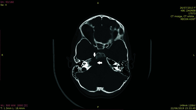 Unrecognized Petrous Apicitis as a Cause of Long-Lasting Headache in a ...