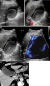 Images in a 67-year-old man who was positive for COVID-19 and who
presented with fever and abdominal pain. (A) Gray-scale US image showed a
large isoechoic mass in the gallbladder lumen, and gallbladder tumor was in
the differential. (B) Limited color Doppler was observed in the gallbladder
wall; therefore, confidence was low that absence of flow in the gallbladder
mass indicated sludge versus tumor. (C) Increased depiction of vascularity
of the gallbladder wall and adjacent liver on microvascular flow image with
no internal vascularity in the gallbladder mass improved confidence in a
diagnosis of tumefactive sludge. (D) Follow-up CT confirmed lack of
contrast-enhanced mass in the gallbladder.