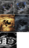 Incidentally detected renal cystic lesion in a 53-year-old male
patient (Bosniak type IV). (A) A mixed cystic and solid lesion with little
internal vascularity on color Doppler images. (B) At microvascular flow
imaging, greater discrete internal vascularity (arrows) was observed within
the solid component of the mass and septations, increasing diagnostic
confidence in diagnosis of Bosniak type IV renal cell carcinoma. (C)
Subsequent contrast-enhanced US imaging depicted vascular septations and
mural nodules, consistent with cystic renal cell carcinoma. (D) Subsequent
CT confirmed presence of cystic renal cell carcinoma.