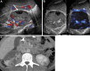 Images in a 28-year-old man with history of trauma. (A) US Doppler
image depicted a heterogeneous area in the right kidney with relative
paucity of flow in the mid and lower pole. Hypoechoic area (white arrow)
within infarcted zone represented laceration with hemorrhage and fluid,
which was observed at CT. (B) Noncontrast microvascular flow image clearly
demarcated the area without vascularity that was confirmed on the (C)
subsequent contrast-enhanced CT image.