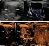 Images of hepatocellular carcinoma in a 16-year-old girl with
cryptogenic cirrhosis who was found to have a focal liver lesion increasing
in size on serial US images. (A, B) Longitudinal gray-scale image through
the right liver lobe. (A) On baseline US image, the lesion (arrows) was
slightly hyperechoic with a hypoechoic halo. (B) Microvascular flow imaging
showed hypertrophic peripheral vessels (thick arrows) with abnormal central
vessels in a haphazard distribution (thin arrows). (C) Contrast-enhanced US
of the focal liver lesion (arrows) showed early arterial enhancement at 26
seconds after administration of contrast agent, with more avid arterial
enhancement at 31 seconds and subsequent late washout at 3 minutes 42
seconds.
