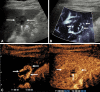 Longitudinal images through the left liver lobe of hemangioma in a
39-year-old man referred for investigation of microscopic hematuria, noted
to have an incidental solitary liver lesion at US. (A) B-mode scan showed an
isoechoic lesion (long arrows) with an eccentric hypoechoic component (short
arrow). (B) At microvascular flow imaging, there were peripheral globular
vessels observed in the periphery (arrows) of the focal liver lesion. (C) A
contrast-enhanced US examination depicted globular enhancement at 18 seconds
(short arrows), centripetal filling of the lesion (long arrows), with
incomplete filling attributed to either a thrombus or scar and hyalinization
(short arrow) at 39 seconds of contrast agent administration.