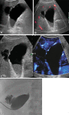 (A) Gray-scale US image shows irregular gallbladder wall in a
65-year-old female patient with upper abdominal pain. There is a fluid
collection in the liver adjacent to the gallbladder, as seen. (B) Power
Doppler mode shows only limited vascularity in the most superficial portion
of the gallbladder wall. (C) Microvascular flow image and gray-scale image
depicted diffuse vascularity in the gallbladder wall, without definite blood
flow in the irregular portion of the gallbladder wall of concern. This
increased confidence in diagnosis of gallbladder wall perforation, with
communication with the adjacent intrahepatic collection. (D) Spot image from
cholecystostomy tube placement confirmed focal perforation of the
gallbladder with contrast leak into the adjacent collection.