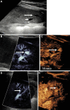 Longitudinal US image in the spleen in a 14-year-old boy who fell on his
elbow while playing soccer, sustaining a grade 4 splenic laceration. (A) Day 5
postinjury US image showed a small anechoic lesion within the splenic fracture
plane (long arrow) adjacent to splenic vessels (short arrow). (B) Microvascular
flow image showed a pseudoaneurysm of the splenic artery (arrow), confirmed on a
(C) contrast-enhanced US (CEUS) image (arrow) at 55 seconds after contrast agent
administration. A follow-up examination 3 days later, with both microvascular
flow imaging (D) and CEUS (E), showed that the pseudoaneurysm (arrows in D and
E) had spontaneously thrombosed without any intervention.