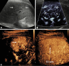 Longitudinal image through the right liver lobe in a 14-year-old girl
with a background fatty liver and an incidental focal liver lesion. (A)
B-mode US showed a focal liver lesion (arrows) of low reflectivity compared
with the background liver parenchyma, measuring 58 × 47 × 36
mm. (B) Microvascular flow image of the lesion showed a so-called spoke
wheel distribution of vessels (arrows). (C) Contrast-enhanced US performed
at the arterial phase confirmed this pattern of spoke wheel vascularization
(horizontal arrow), with central vessels at 13 seconds after contrast agent
injection and hyperenhancement of the lesion (vertical arrow) at 38 seconds
after contrast agent administration. The lesion had complete fill-in and no
washout, with no observed central scar. A subsequent MRI scan verified the
findings at US of a focal nodular hyperplasia (not shown).