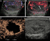 Images in a 50-year-old man with no predisposing factors and sudden
onset of pain in the left testis. (A) Color Doppler image shows hypoechoic
area in the left testis with no definite internal vascularity. (B)
Microvascular flow image better depicted surrounding vascularity extending
up to the margins of the hypoechoic area (arrow) compared with the color
Doppler image, which increased its diagnostic value. (C) Contrast-enhanced
US (CEUS) showed no internal vascularity consistent with segmental
infarction. The CEUS image gave the best definition of the vascularized
borders. Contraction and resolution were identified over 6 months of serial
US.