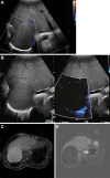 Hemorrhagic hepatic cyst in a 55-year-old man with hepatic mass. (A)
Gray-scale image with color Doppler showed a solid mass with isoechoic
echotexture in the liver without color flow at Doppler. (B) Corresponding
microvascular flow imaging (MVFI) did not show any internal vascularity;
however, some of the posterior aspects were considered too deep for
definitive characterization. (C) The lesion was hyperintense at
contrast-enhanced T1-weighted MRI. (D) No enhancement was identified on the
subtraction image, confirming the assessment at MVFI.