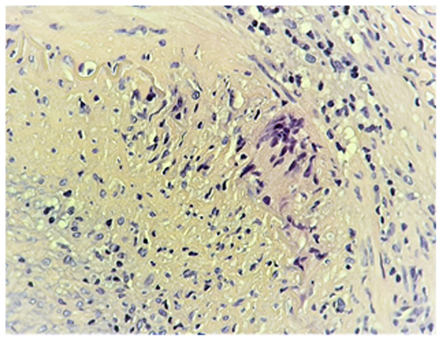 Role of temporal artery resection in Horton's arteritis (Review) - PMC