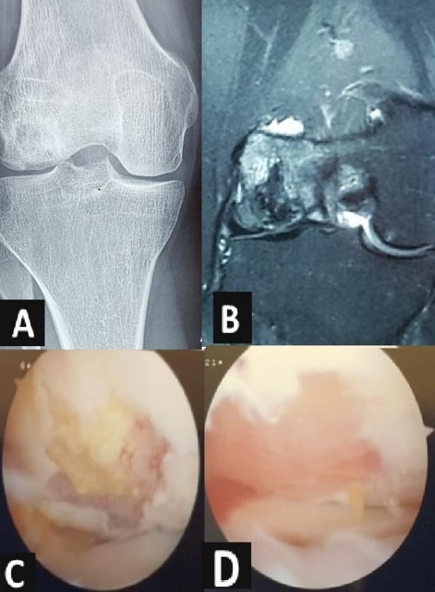 Figure 1. Secondary osteonecrosis of femoral lateral condyle treated arthroscopically by debridement, bone marrow stimulation and implant of scaffold. (A) X-ray plain. (B) MRI image showing epiphysis involvement. (C) Arthroscopic view of lesion. (D) Post-treatment arthroscopic view.