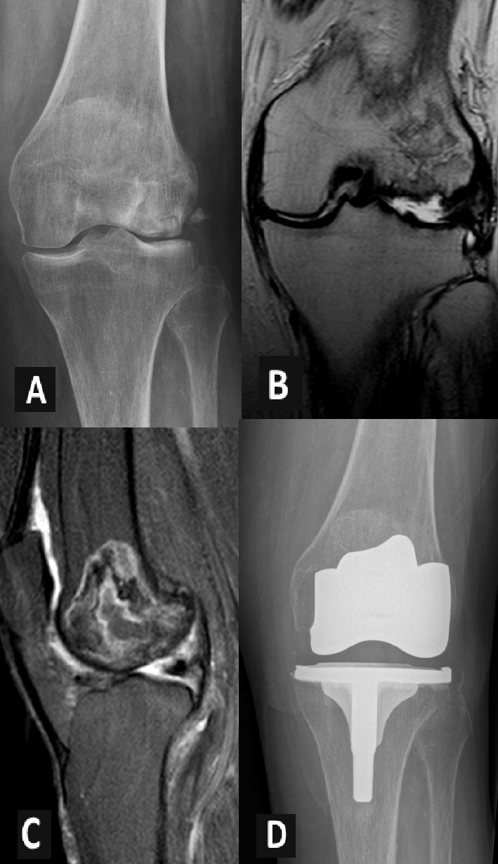 Figure 2. SON evolved into end-stage osteoarthritis. (A) X-ray plain. (B and C) MRI image showing knee osteoarthritis and involvement of epiphysis and metaphysis. (D) Patient treated with TKA.