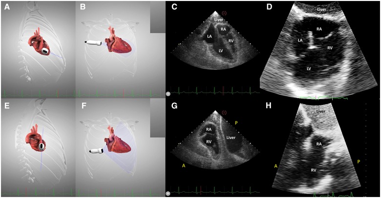 Transhepatic echocardiography: a novel approach for imaging in left ...