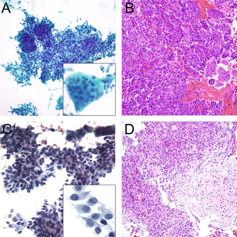 Immunohistochemistry For Histone H3g34w And H3k36m Is Highly Specific 