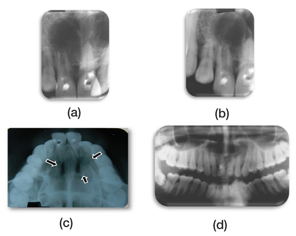 Management Of Large Radicular Cyst By Conservative Surgical Approach A Case Report Pmc 5221