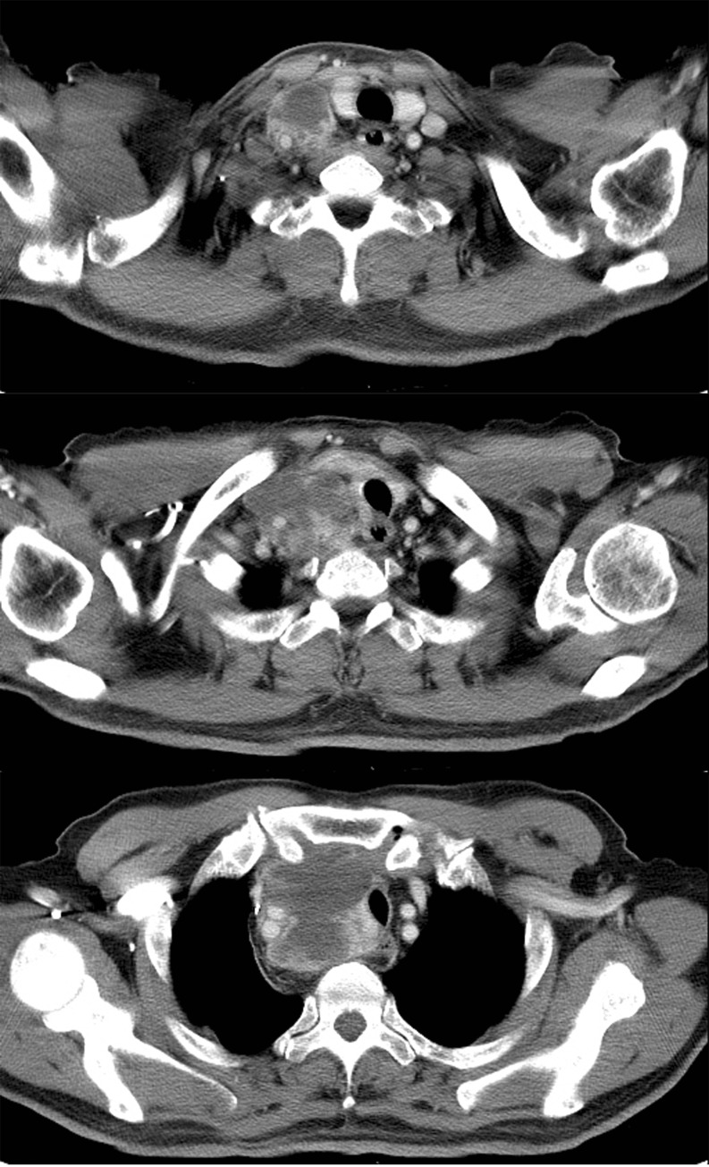 Primary Malignant Fibrous Histiocytoma in Mediastinum: Imaging with 18F ...