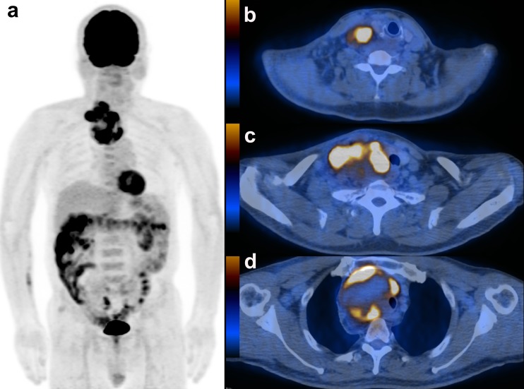 Primary Malignant Fibrous Histiocytoma in Mediastinum: Imaging with 18F ...