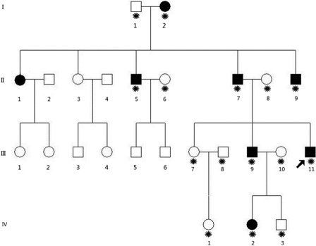 A novel T→G splice site mutation of CRYBA1/A3 associated with autosomal ...