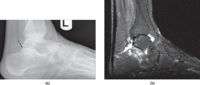 Lower extremity and pelvic stress fractures in athletes - PMC