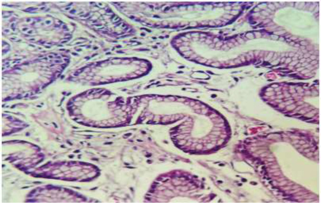 Comparison Of Portal Hypertensive Gastropathy And Gastric Antral ...