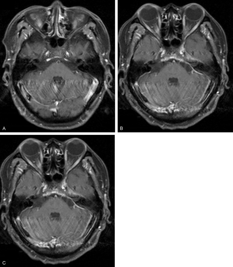 Pachymeningitis as a manifestation of ANCA-associated vasculitis: a ...