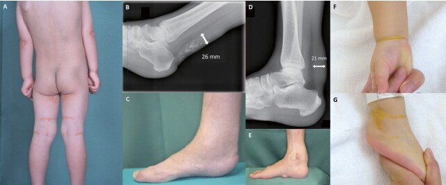 Fig.2. Xanthomas in patients with dyslipidemias