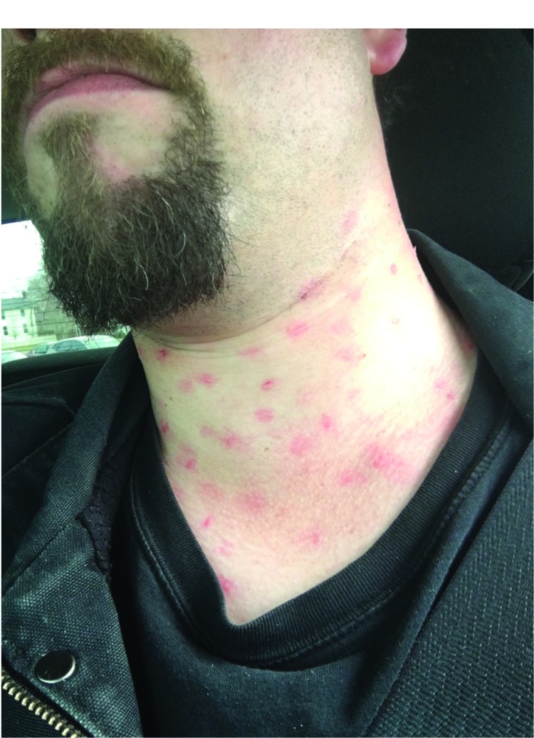 The figure above is a photograph showing a patient actor displaying moulage-simulated measles rash during mystery patient drills in New York City during December 2015–May 2016.