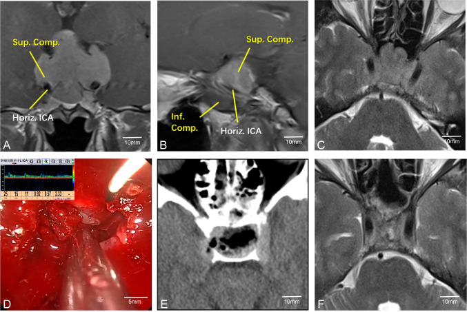 MRI and CT scans with surgical imagery of the cavernous sinus region. Images A and B, labeled with “Sup. Comp.”, “Inf. Comp.”, and “Horiz. ICA”, show areas of interest. Image C shows another MRI view. Image D features a surgical procedure with a Doppler reading overlay. Image E is a CT scan of the sinus area. Image F offers a final MRI view. Scale bars indicate size reference.