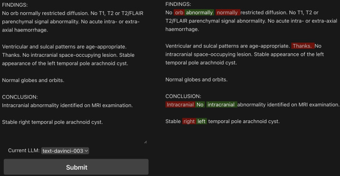 Web interface for review of large language model–detected errors on a sample generated radiology report. Example shown for text-davinci-003 model. In red are the sections that have been removed, in green the model’s suggestions. Examples of word omission, nonsense phrases, and internal inconsistency (eg, “right” changed to “left”) are included in the sample report for demonstration.