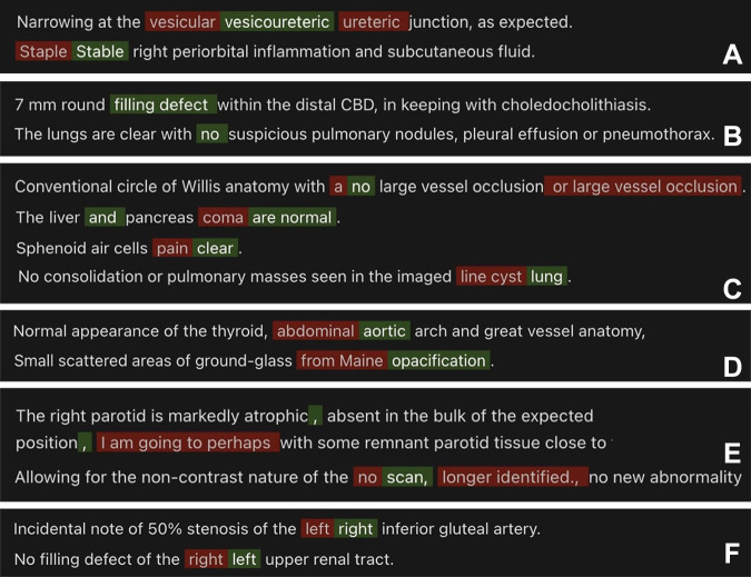 GPT-4 correctly detected multiple types of clinically significant errors (red indicates errors, green indicates correction): (A) homonym error, (B) omission error, (C) nonsense phrase, (D) translational error, (E) extraneous statements, and (F) internal inconsistency error.