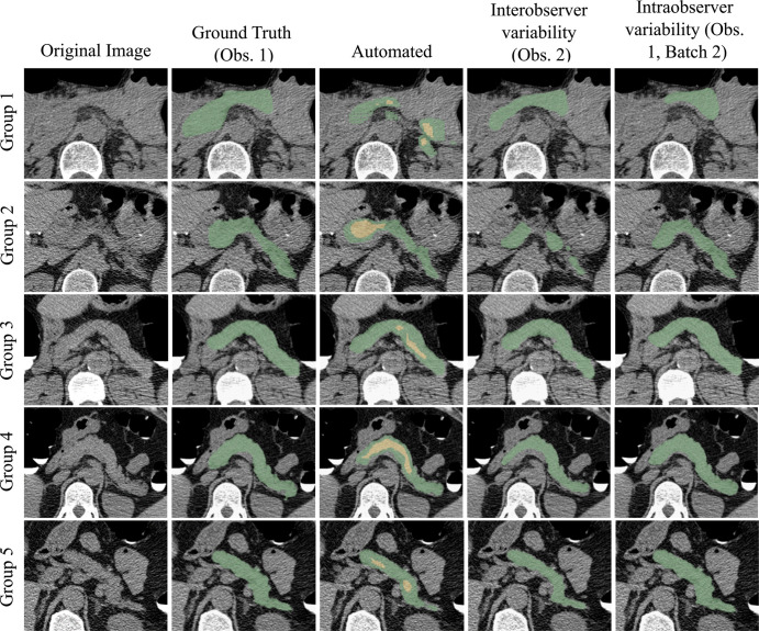 Pancreas segmentations in patients from each of the five visceral fat groups. Segmentation performance is better for patients with higher visceral fat (group 5 being the highest). Visceral fat percentages at the L1 level for the specific patients shown here were 9.81% in group 1, 13.72% in group 2, 20.19% in group 3, 27.88% in group 4, and 32.42% in group 5; Dice similarity coefficients were 0.36, 0.62, 0.78, 0.81, and 0.86, respectively. In the automated segmentation images, the green area indicates full segmentation and the yellow area indicates segmentation after erosion. Obs. = observer.