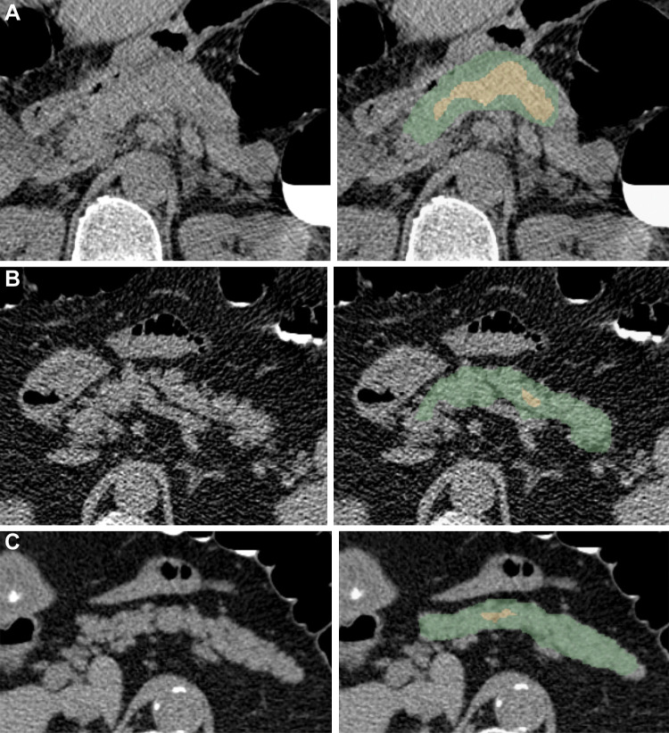 Examples of pancreas segmentations on unenhanced axial abdominal CT images in healthy participants and patients with type 2 diabetes mellitus. Images on left are original CT images, and images on right show segmentations overlaid on the original CT images. (A) Images in a nondiabetic 61-year-old man with average pancreas CT attenuation of 35.50 HU ± 47.96 and pancreatic volume of 97.6 mL. (B) Images in a 59-year-old man with type 2 diabetes who was diagnosed 144 days before CT. Average pancreas CT attenuation was 20.66 HU ± 81.99 and pancreatic volume was 77.10 mL. (C) Images in a 67-year-old man with type 2 diabetes who was diagnosed 595 days after CT. Average pancreas CT attenuation was 18.46 HU ± 48.30 and pancreatic volume was 72.88 mL. The green area indicates full segmentation and the yellow area indicates segmentation after erosion.