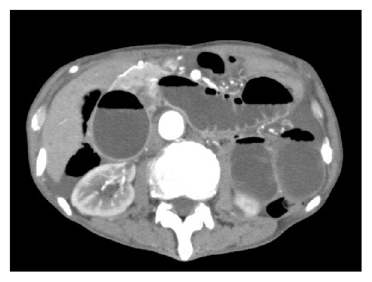 Afferent loop syndrome after roux en y total gastrectomy caused by