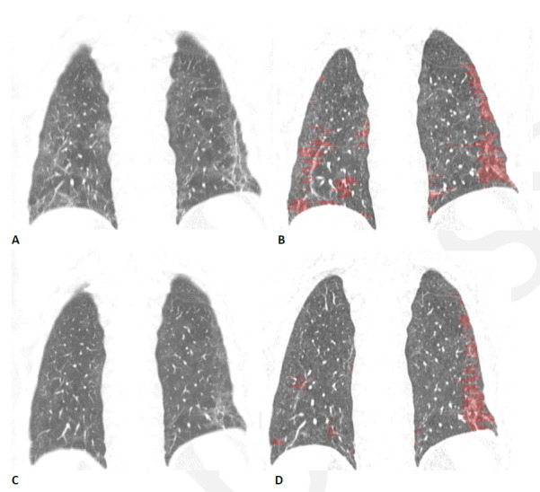 Quantitative CT assessment of linear/reticular abnormality following COVID-19 acute respiratory distress syndrome (ARDS) in a 59-year-old woman. (A) Coronal CT obtained ten weeks after onset of infection shows ground glass abnormality with linear and reticular abnormality at both bases. (B) Corresponding quantitative CT image delineates the linear/reticular abnormality, quantified at 10.5% of the lung volume. (C) Four months later, the extent of ground glass and of linear/reticular abnormality has decreased substantially. Symptoms had resolved, and pulmonary function had returned to normal. (D) Corresponding quantitative CT indicates decrease in linear/reticular abnormality, now 4.6%.