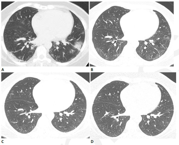 59-year-old woman with sequelae of COVID-related acute respiratory distress syndrome (ARDS). (A) CT on admission shows patchy nodular consolidation. A halo of ground glass opacity is present around the largest left lower lobe nodule. The patient subsequently developed ARDS. (B) Two months later, the consolidation has resolved with moderate ground glass abnormality. (C) Three months after admission there is further improvement in ground glass. (D) Eleven months after admission there is still mild residual ground glass abnormality, but symptoms had resolved and pulmonary function was normal.