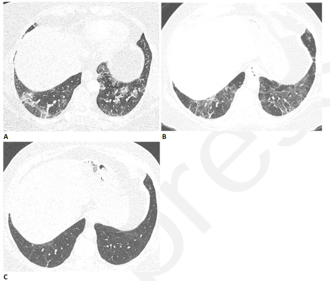 59-year-old woman with sequelae of COVID-related acute respiratory distress syndrome (ARDS). (A) CT on admission shows patchy consolidation and ground glass abnormality. This subsequently progressed to ARDS. (B) Two months later, the consolidation has resolved but there is moderate ground glass abnormality, multifocal linear abnormality and mild bronchiectasis. (C) Seven months after admission, these abnormalities had almost completely resolved, and restrictive pulmonary function also resolved.