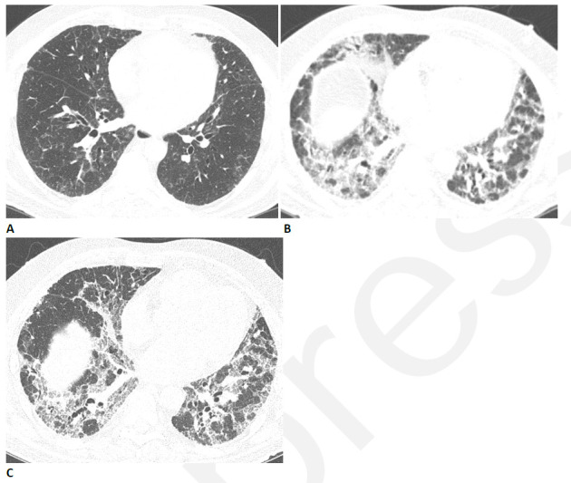 Progressive pulmonary fibrosis in a 67-year-old man with a history of relatively mild, stable fibrotic hypersensitivity pneumonitis. (A) Baseline CT shows mild ground glass and reticular abnormality. (B) CT angiogram obtained two months after infection shows substantially increased reticular abnormality with mild traction bronchiectasis. (C) CT obtained two months later shows increased traction bronchiectasis indicating progressive fibrosis.